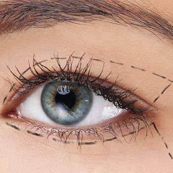 Blepharoplasty  (Eyelid/Eyebag Surgery)
